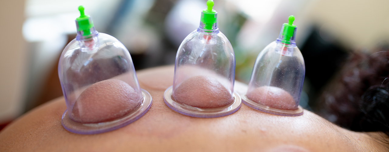 Cupping Midland Sports Rehab Michigan
