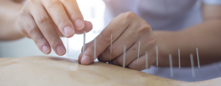 Dry Needling Midland Sports Rehab Michigan