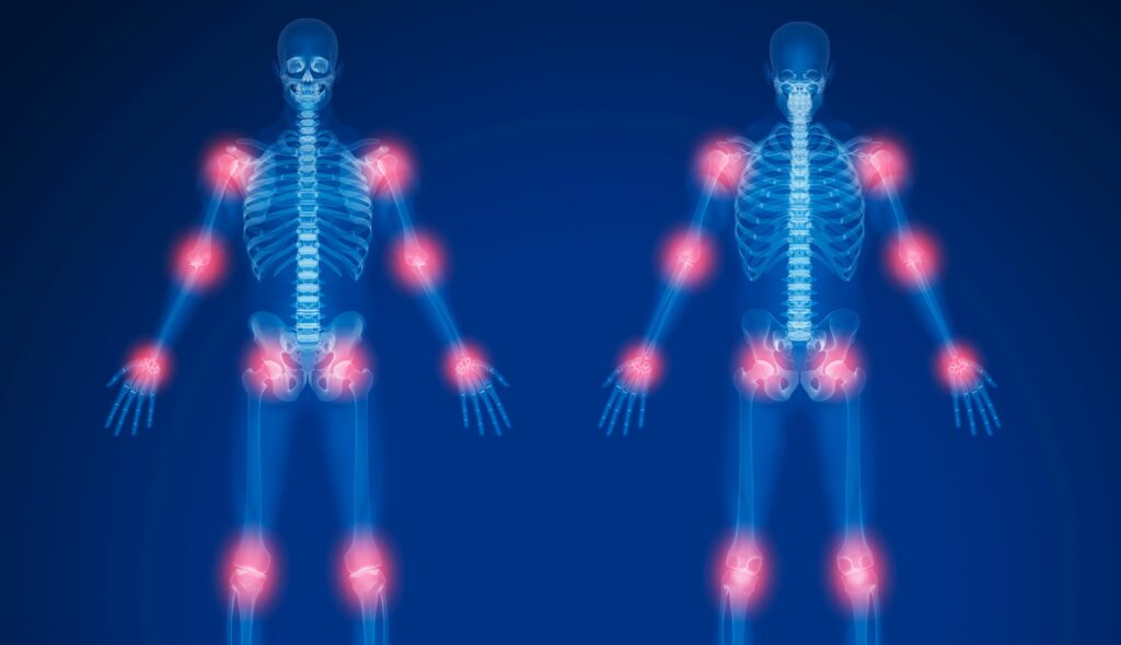 Treat arthritis with Physical Therapy at Midland Sports Rehab and Freeland Sports Rehab