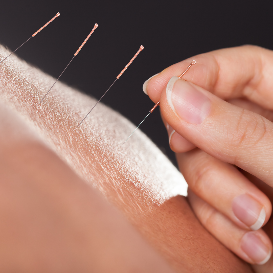 Acupuncture for mental health