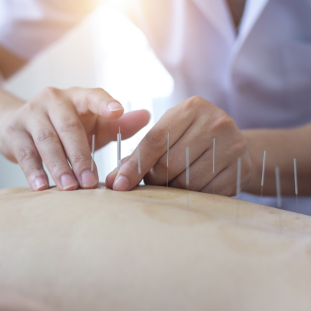 Staying active this summer with Acupuncture