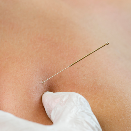 dry needling physical therapy