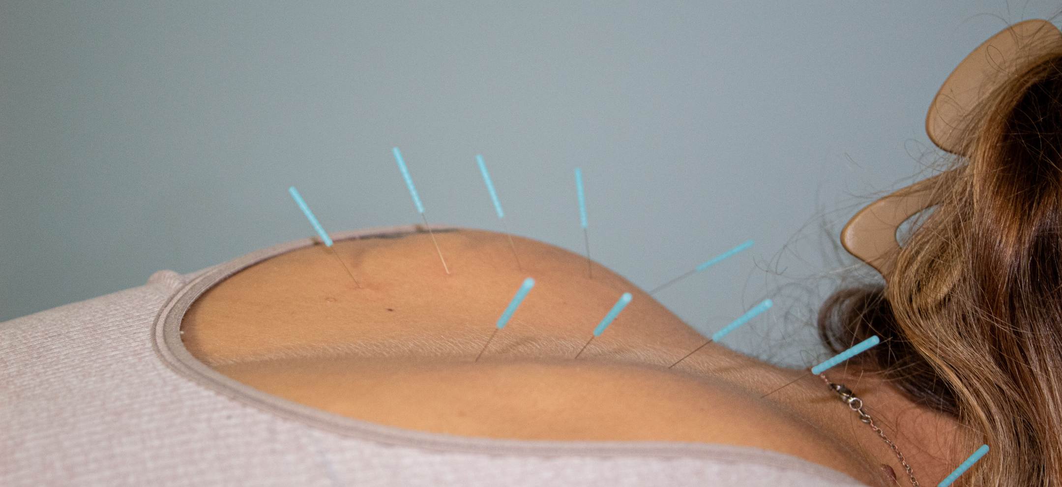 Acupuncture at Midland Sports Rehab and Freeland Sports Rehab in Midland, Freeland, Saginaw