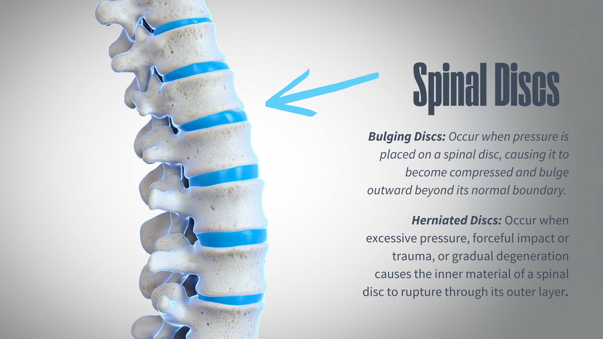 Sciatica, bulging disc, back pain? Decompression Therapy can provide the pain relief you are looking for! 90% of patients experience significant relief with decompression in Midland & Freeland!